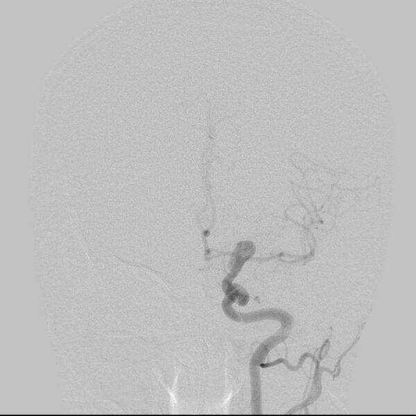 File:Cerebral aneurysm with rupture (Radiopaedia 29933-30458 LT CCA IC 13).jpg