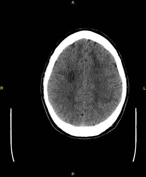 File:Cerebral autosomal dominant arteriopathy with subcortical infarcts and leukoencephalopathy (CADASIL) (Radiopaedia 86108-102051 Axial non-contrast 78).jpg