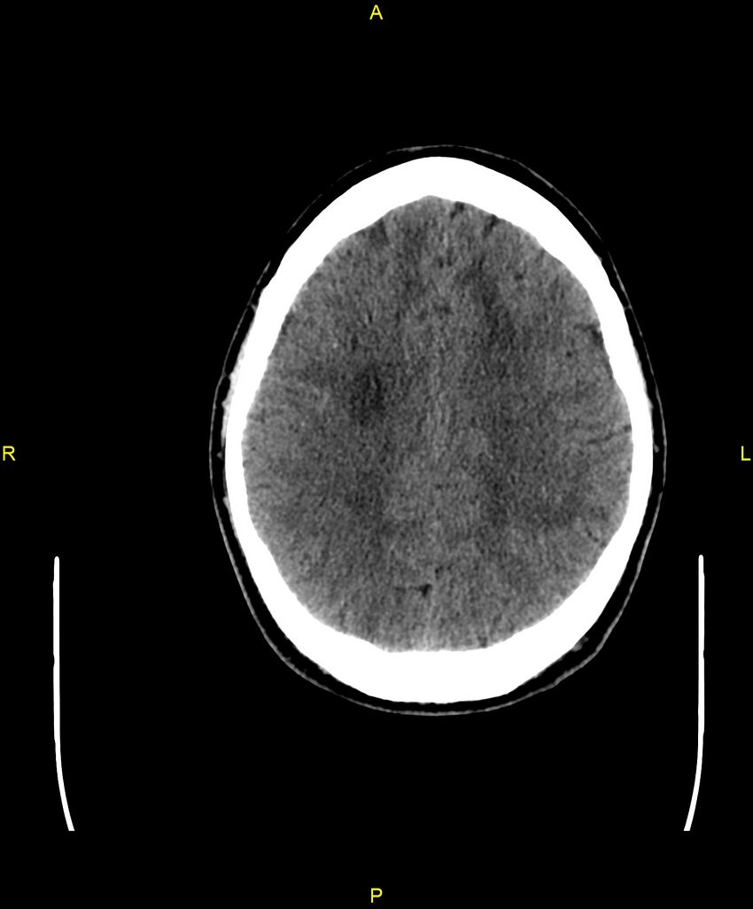 Cerebral autosomal dominant arteriopathy with subcortical infarcts and leukoencephalopathy (CADASIL) (Radiopaedia 86108-102051 Axial non-contrast 78).jpg