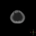 Cerebral contusion (Radiopaedia 48869-53911 Axial bone window 2).jpg