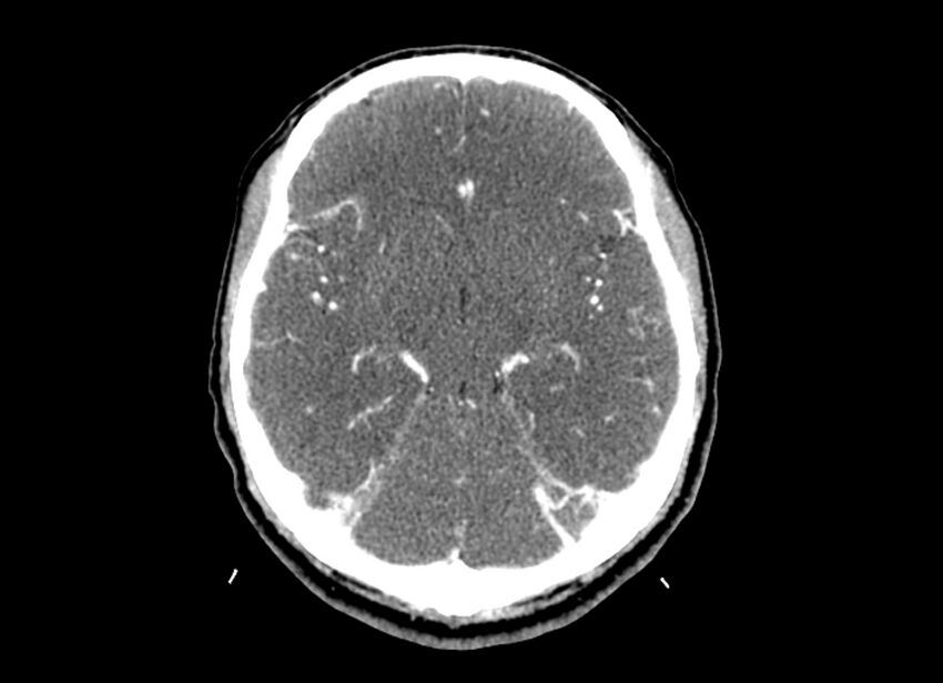 Cerebral edema (Radiopaedia 82519-96661 B 34).jpg