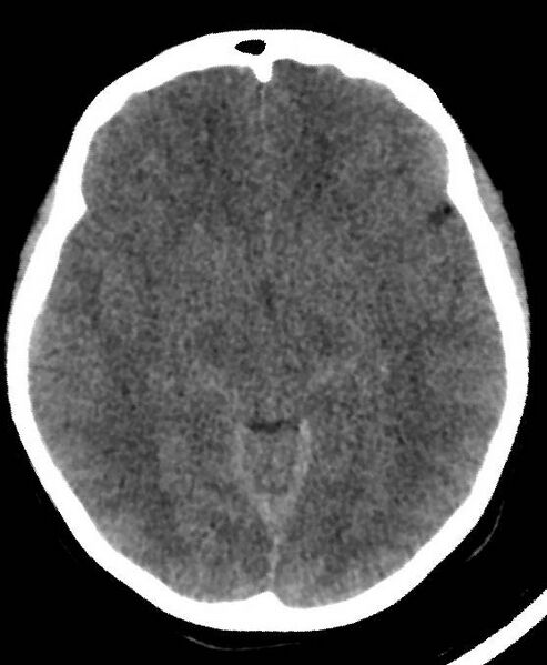 File:Cerebral edema due to severe hyponatremia (Radiopaedia 89826-106937 Axial non-contrast 40).jpg