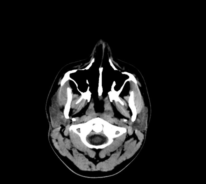 File:Cerebral fat embolism (Radiopaedia 37510-39362 Axial non-contrast 2).jpg
