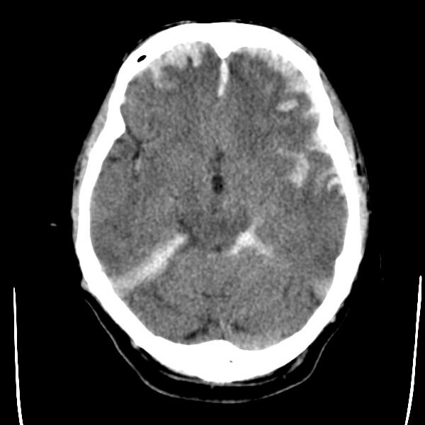 File:Cerebral hemorrhagic contusions (Radiopaedia 23145-23188 Axial non-contrast 14).jpg