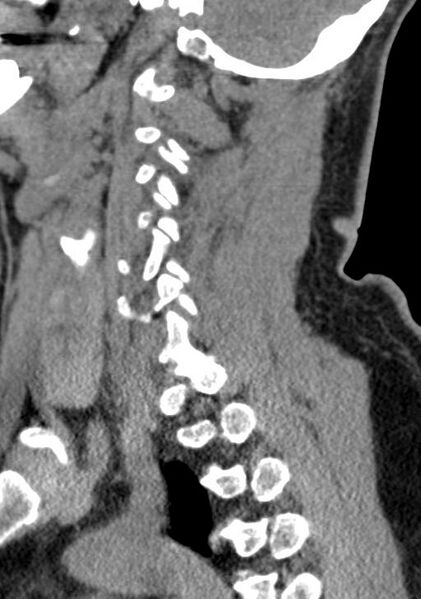 File:Cerebral hemorrhagic contusions and cervical spine fractures (Radiopaedia 32865-33841 G 41).jpg
