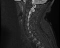 Cervical schwannoma (Radiopaedia 72399-82934 Sagittal STIR 5).jpg