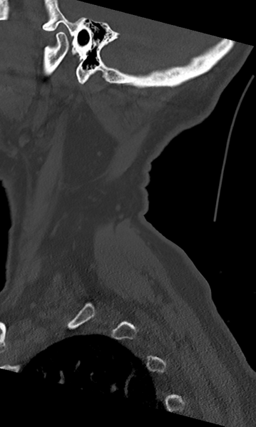 File:Cervical spine fracture - chalk stick (Radiopaedia 39116-41323 Sagittal bone window 6).png