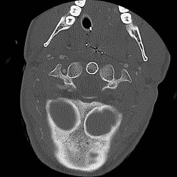 File:Cervical spine fractures with vertebral artery dissection (Radiopaedia 32135-33078 Axial bone window 66).jpg