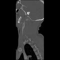 Cervical spine fractures with vertebral artery dissection (Radiopaedia 32135-33078 Sagittal bone window 5).jpg
