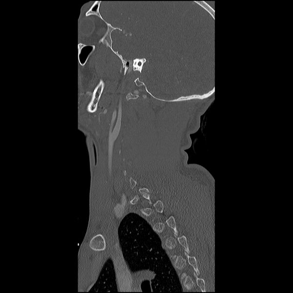 File:Cervical spine fractures with vertebral artery dissection (Radiopaedia 32135-33078 Sagittal bone window 5).jpg