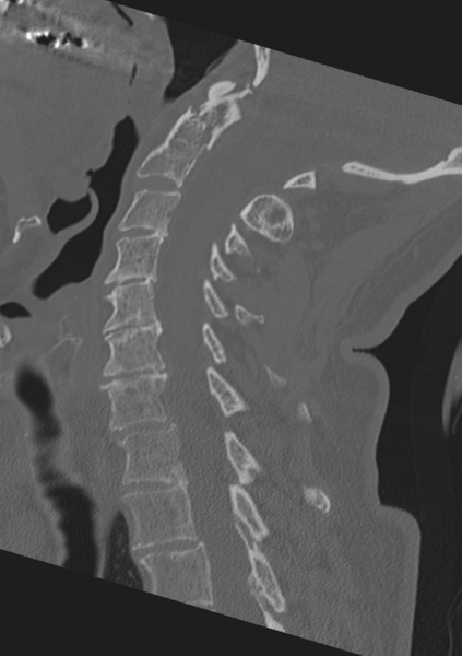 File:Cervical spine fractures with vertebral artery dissection (Radiopaedia 53296-59268 Sagittal bone window 37).png