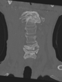 Cervical spondylolysis (Radiopaedia 49616-54811 Coronal bone window 12).png