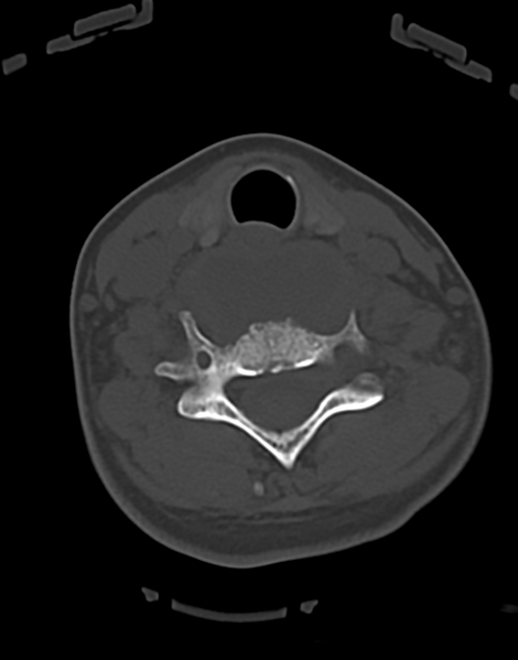 File:Cervical tuberculous spondylitis (Radiopaedia 39149-41365 Axial bone window 36).png