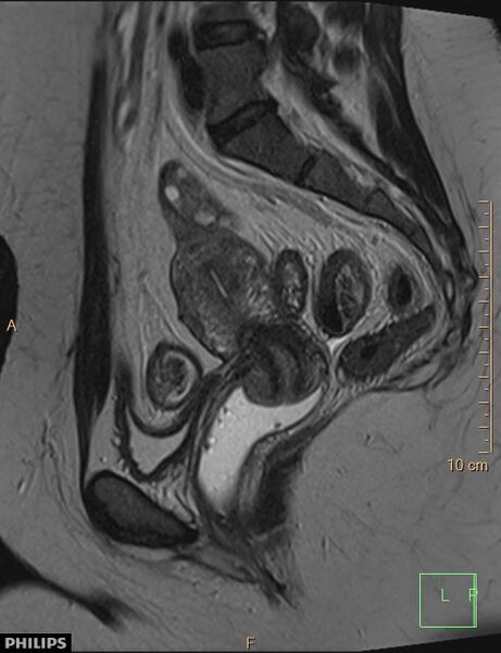 File:Cesarian scar endometriosis (Radiopaedia 68495-78066 Sagittal T2 16).jpg