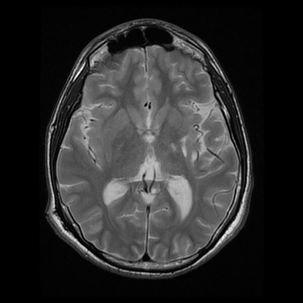 File:Chiasmatic-hypothalamic juvenile pilocytic astrocytoma (Radiopaedia 78533-91235 Axial T2 15).jpg