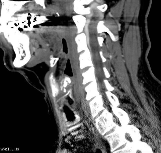 File:Chondrosarcoma - larynx (Radiopaedia 4588-6698 C 3).jpg