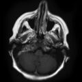 Chondrosarcoma - occipital condyle (Radiopaedia 8969-9744 Axial T1 1).jpg