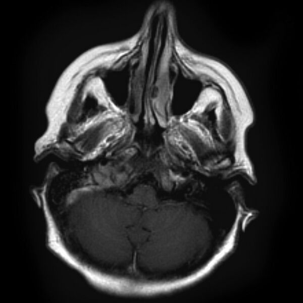 File:Chondrosarcoma - occipital condyle (Radiopaedia 8969-9744 Axial T1 1).jpg