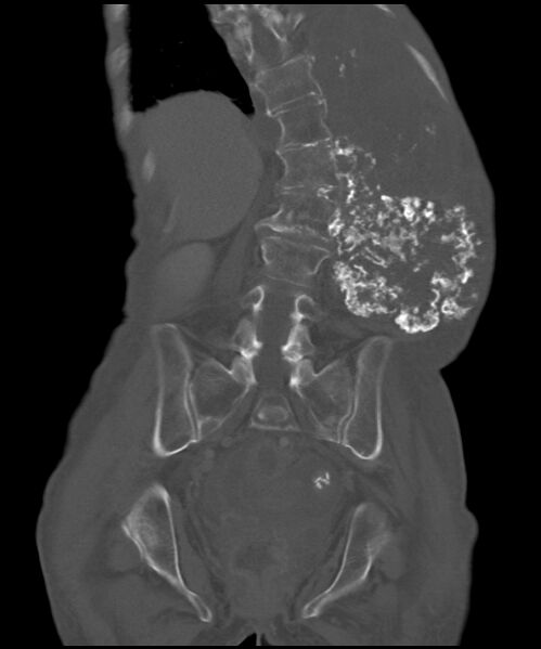 File:Chondrosarcoma of the spine (Radiopaedia 49871-55143 Coronal bone window 10).jpg