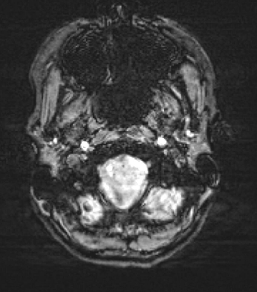 Choroid plexus carcinoma (Radiopaedia 91013-108553 Axial SWI 9).jpg