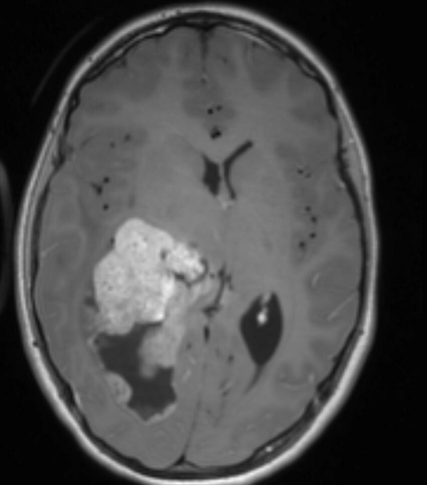 Choroid plexus carcinoma (Radiopaedia 91013-108553 Axial T1 C+ 134).jpg