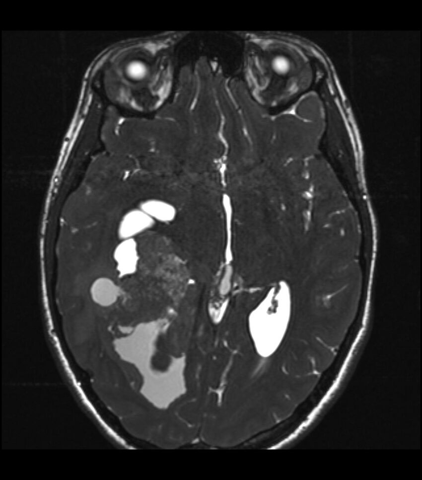 Choroid plexus carcinoma (Radiopaedia 91013-108553 Axial T2 CISS 31).jpg