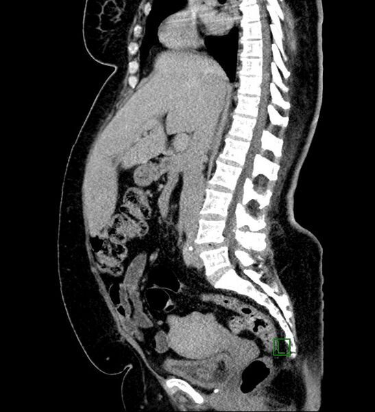 File:Chromophobe renal cell carcinoma (Radiopaedia 84239-99519 G 67).jpg