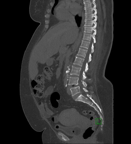 File:Chromophobe renal cell carcinoma (Radiopaedia 84239-99519 Sagittal bone window 57).jpg