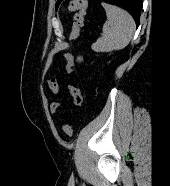 File:Chromophobe renal cell carcinoma (Radiopaedia 84286-99573 C 24).jpg