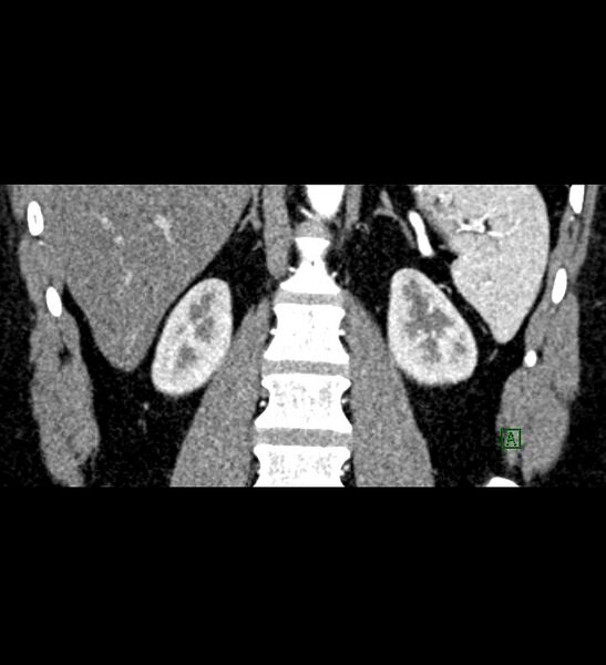File:Chromophobe renal cell carcinoma (Radiopaedia 84286-99573 E 63).jpg
