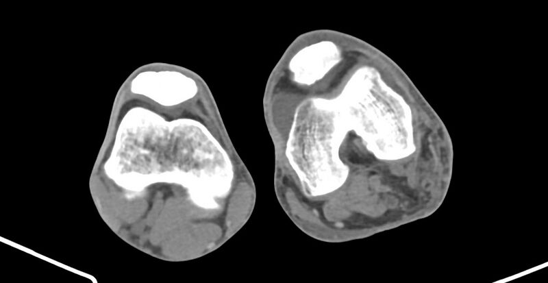 File:Chronic osteomyelitis (with sequestrum) (Radiopaedia 74813-85822 Axial 365).jpg