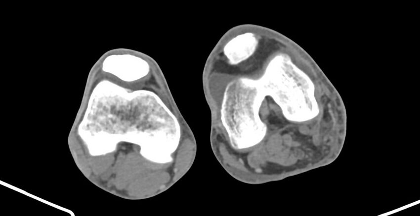Chronic osteomyelitis (with sequestrum) (Radiopaedia 74813-85822 D 184).jpg