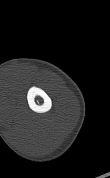 File:Chronic osteomyelitis of the distal humerus (Radiopaedia 78351-90971 Axial bone window 30).jpg