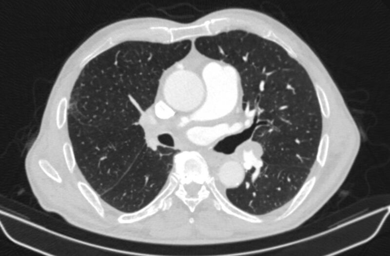 File:Chronic pulmonary embolism (Radiopaedia 91241-108843 Axial lung window 44).jpg