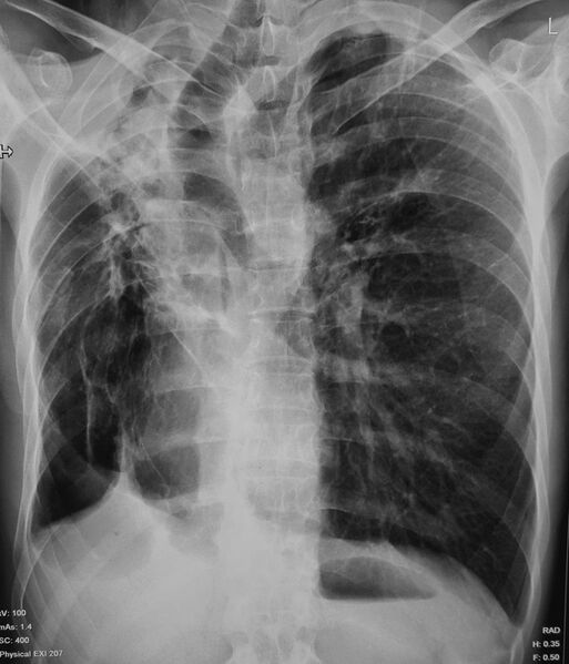 File:Chronic pulmonary tuberculosis (Radiopaedia 75252).jpg