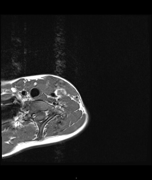 File:Chronic reactive multifocal osteomyelitis (CRMO) - clavicle (Radiopaedia 56406-63071 Axial T1 1).jpg