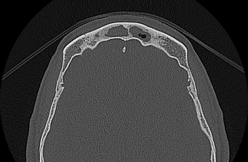 File:Chronic rhinosinusitis (Radiopaedia 65079-74075 Axial bone window 76).jpg