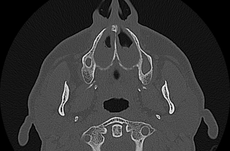 File:Chronic rhinosinusitis (Radiopaedia 65079-74075 Axial bone window 8).jpg
