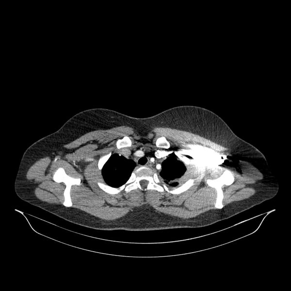 File:Chronic thromboembolic pulmonary hypertension (CTEPH) (Radiopaedia 74597-85532 Axial C+ CTPA 139).jpg