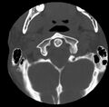 Clay-shoveler fracture (Radiopaedia 22568-22590 Axial bone window 7).jpg