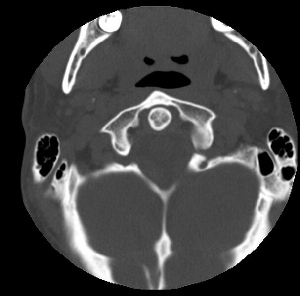 File:Clay-shoveler fracture (Radiopaedia 22568-22590 Axial bone window 7).jpg
