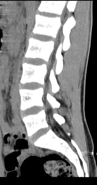 File:Clear cell meningoma - lumbar spine (Radiopaedia 60116-67691 A 25).png