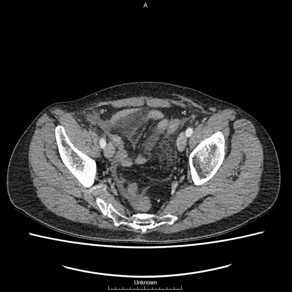 File:Closed loop bowel obstruction and ischemia (Radiopaedia 86959-103180 A 75).jpg