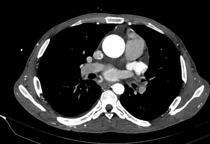 File:Coarctation of aorta with aortic valve stenosis (Radiopaedia 70463-80574 A 91).jpg