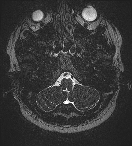 File:Cochlear incomplete partition type III associated with hypothalamic hamartoma (Radiopaedia 88756-105498 Axial T2 29).jpg
