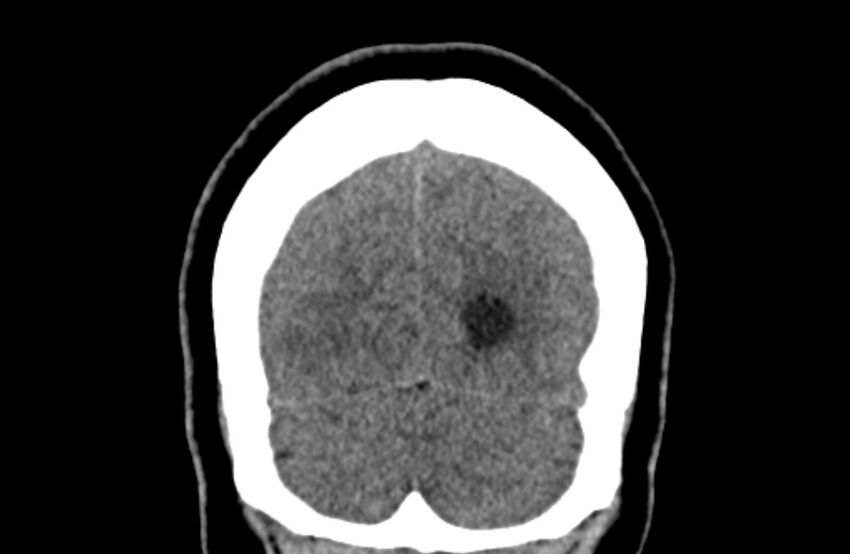 Colloid cyst (Radiopaedia 53180-59146 Coronal non-contrast 74).jpg