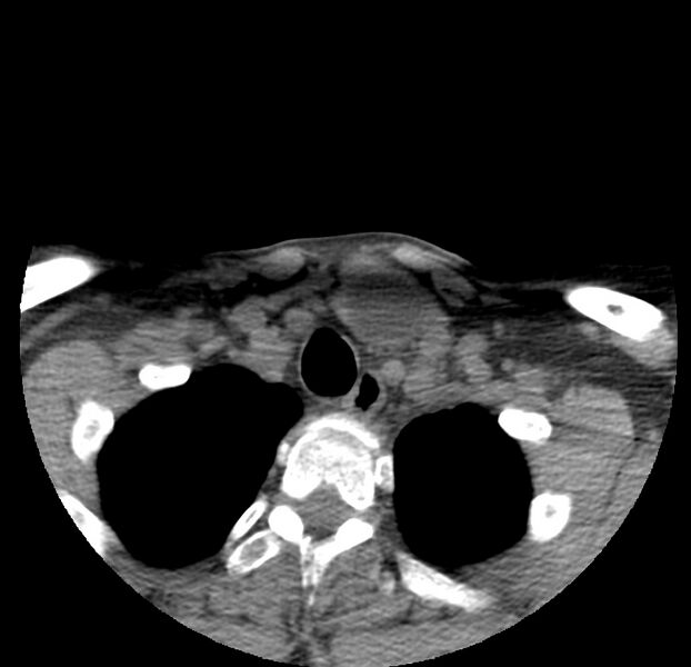 File:Colloid cyst of thyroid (Radiopaedia 22897-22923 Axial non-contrast 49).jpg