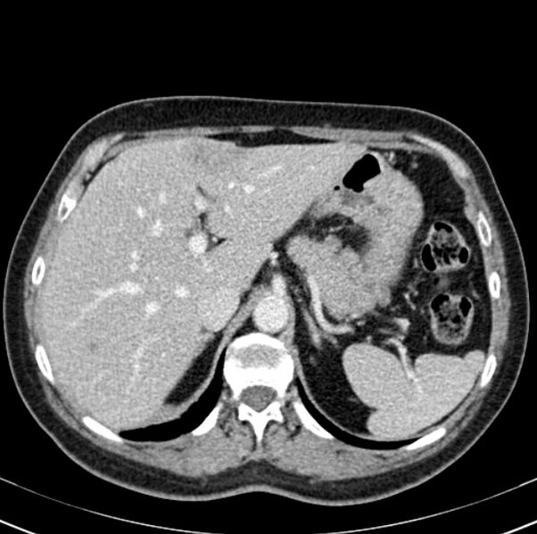 File:Colon carcinoma with hepatic metastases (Radiopaedia 29477-29961 A 27).jpg