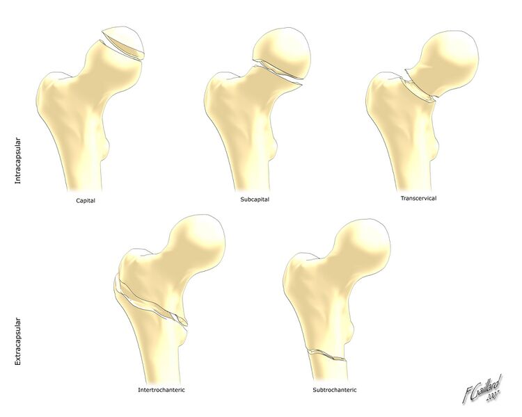 File:Femoral neck fracture classification (Radiopaedia 29198).jpg