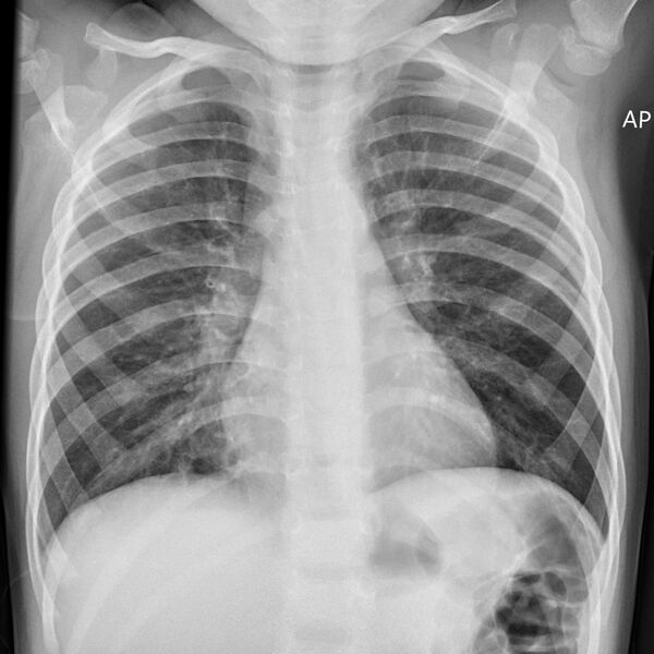 File:Gas in left shoulder joint (normal) (Radiopaedia 27463).jpg